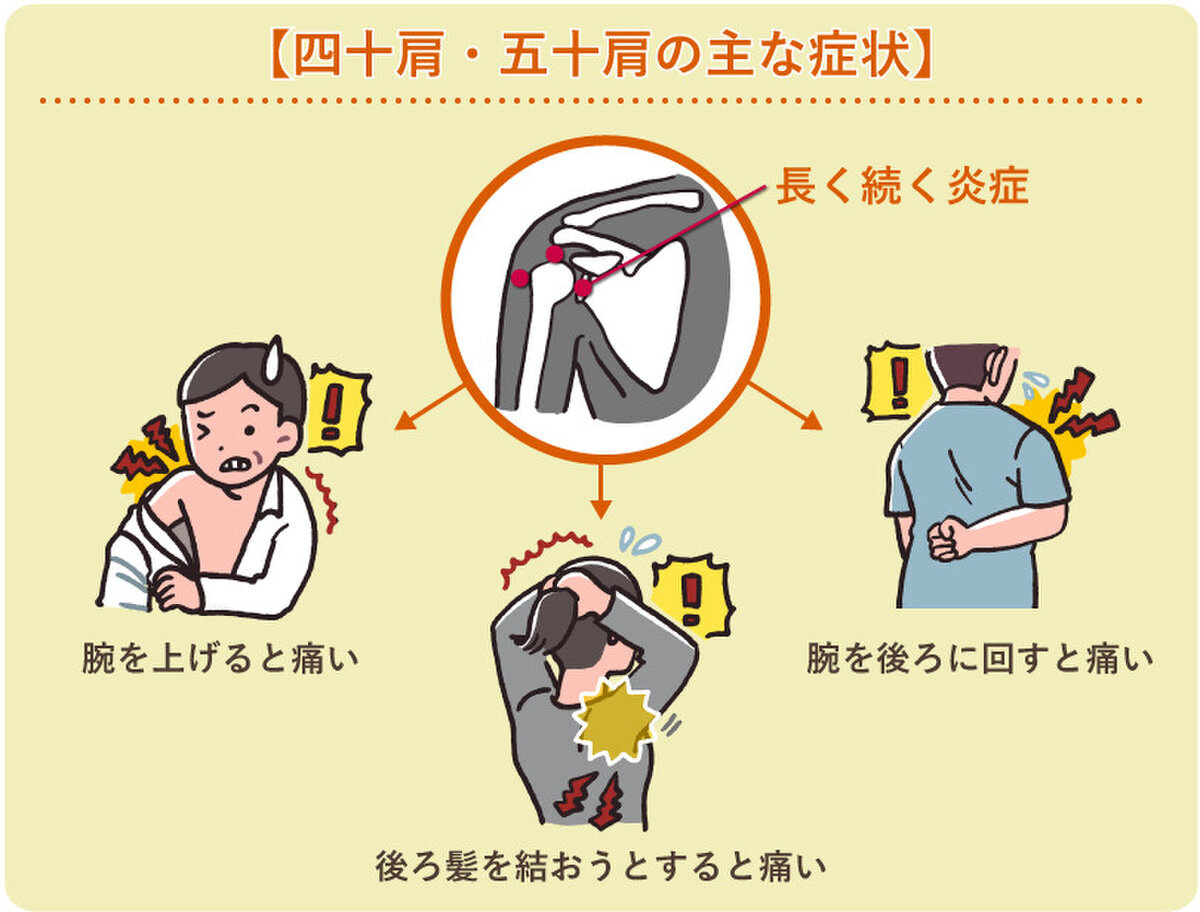 【中国健康法】四十肩・五十肩の正体と治療法とは？の画像