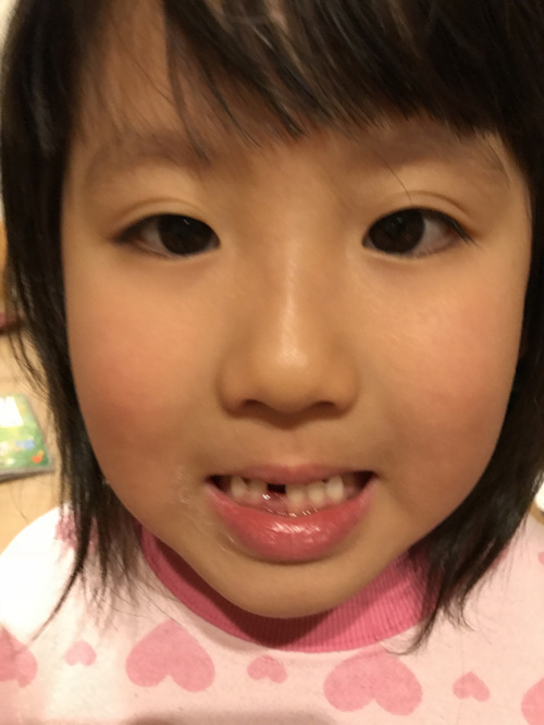 姫の歯が…の画像